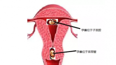 宫颈妊娠要做哪些检查 宫颈妊娠的临床表现
